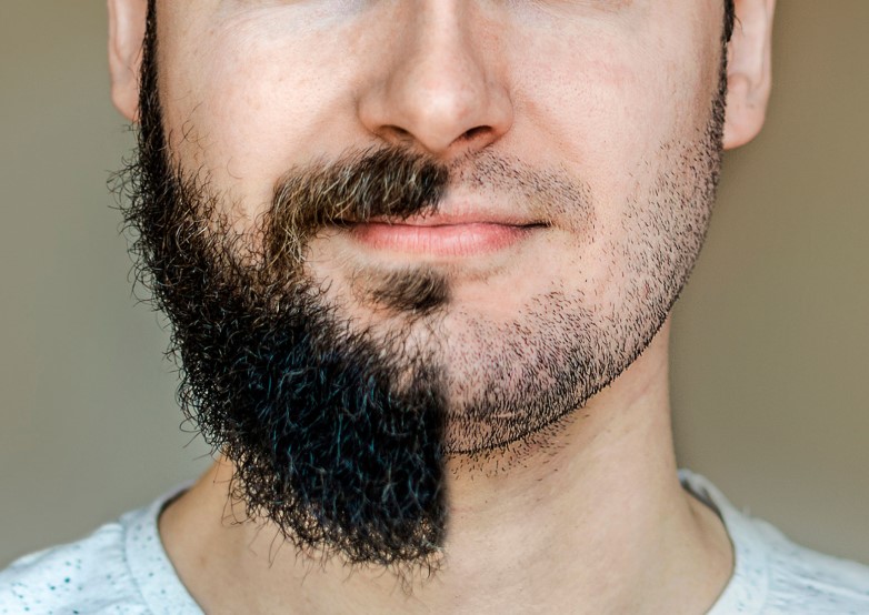 pelade-barbe