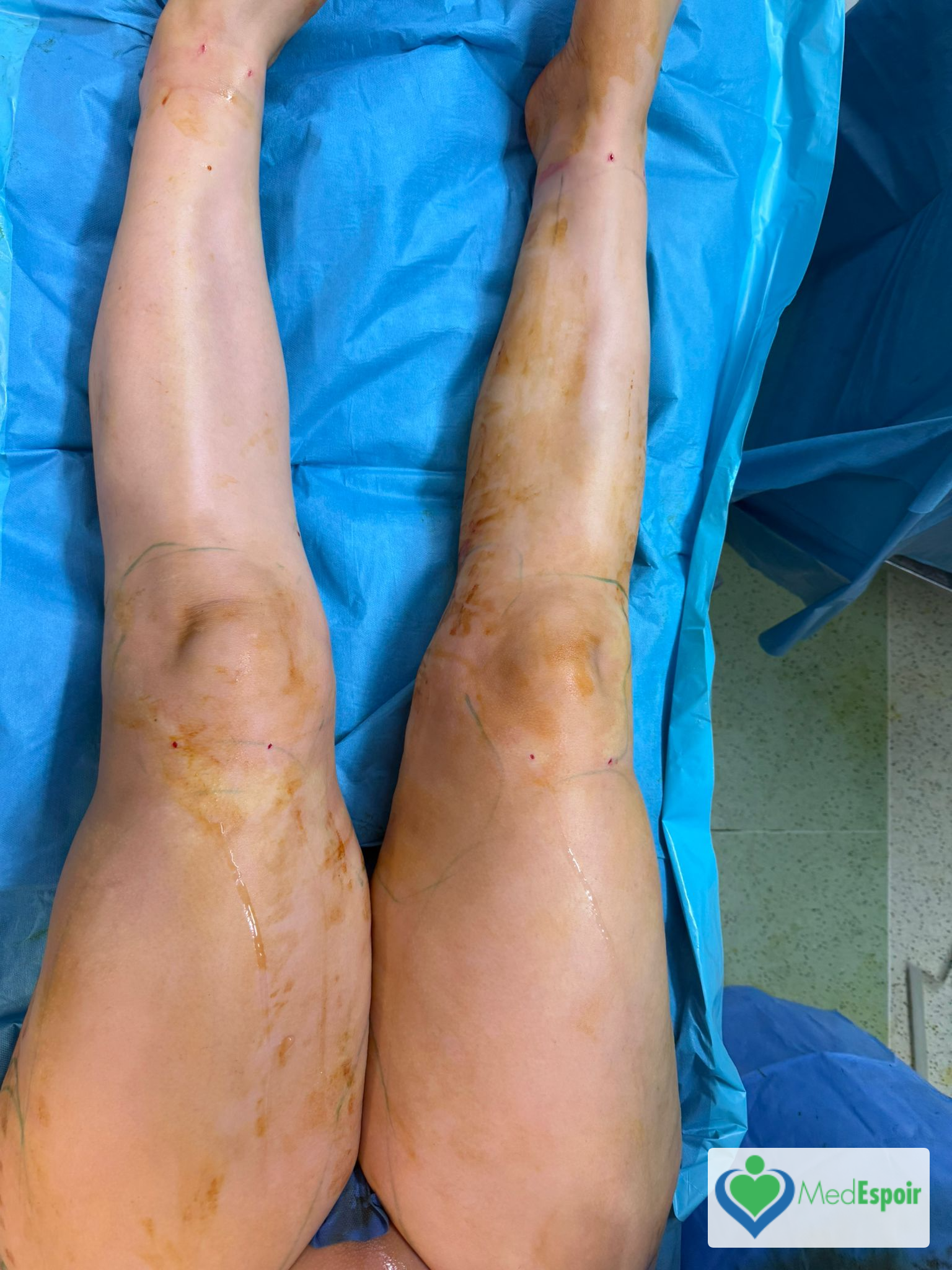 jambes atteintes de lipœdème