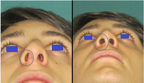 correction déviation cloison nasale septoplastie
