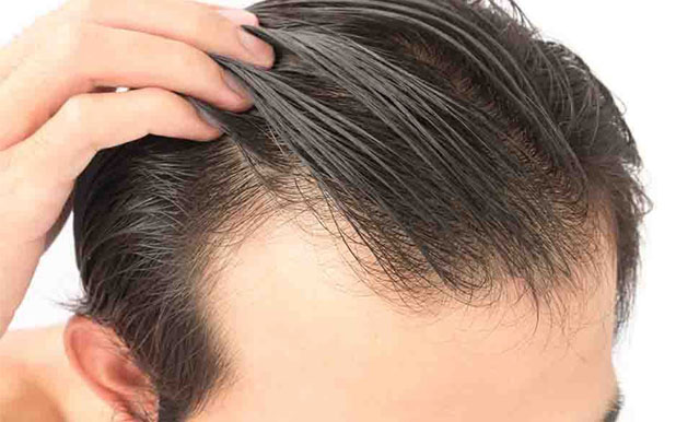 greffe cheveux FUE