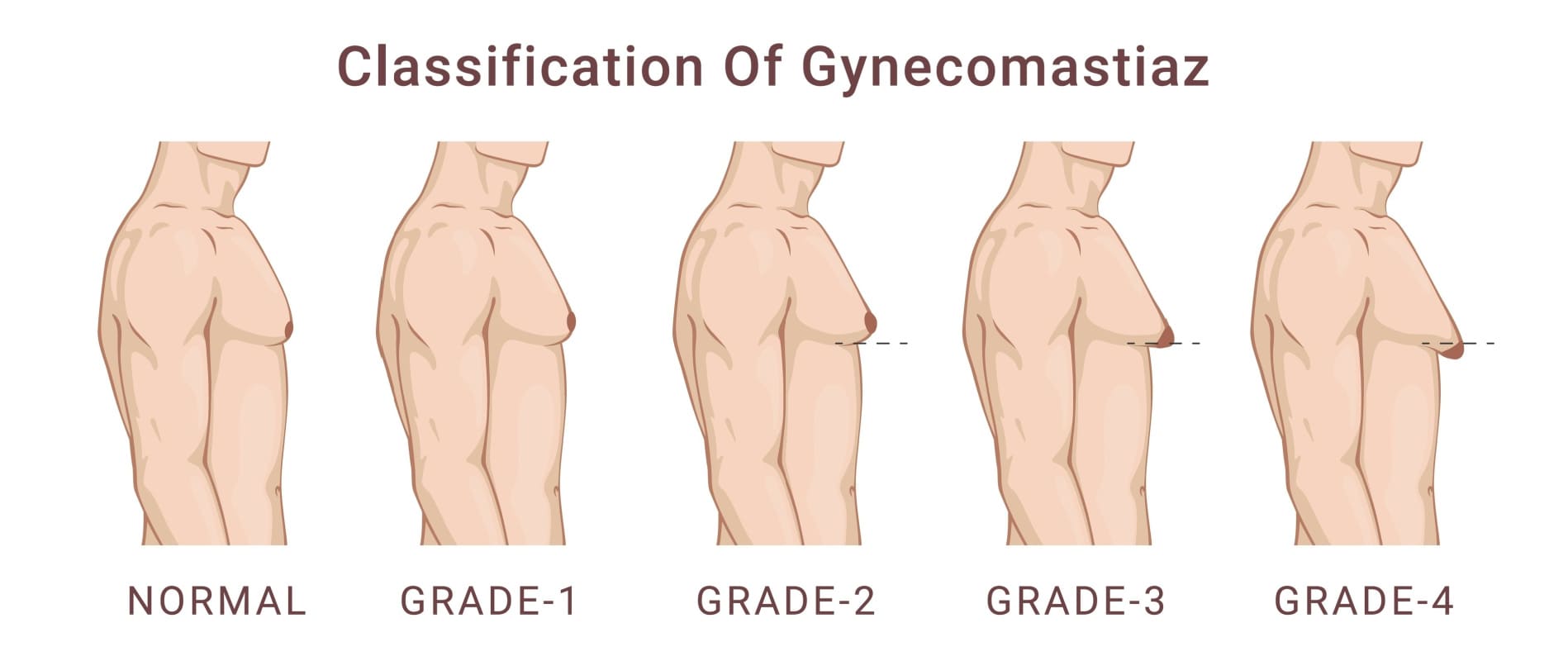 gynecomastie chirurgie