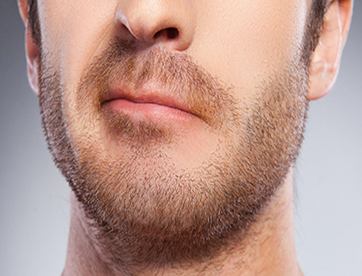 implant-barbe-prix