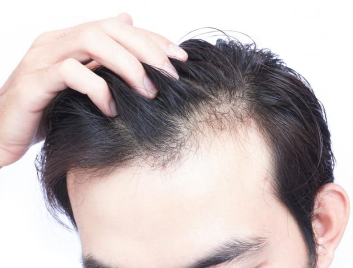 causes perte cheveux
