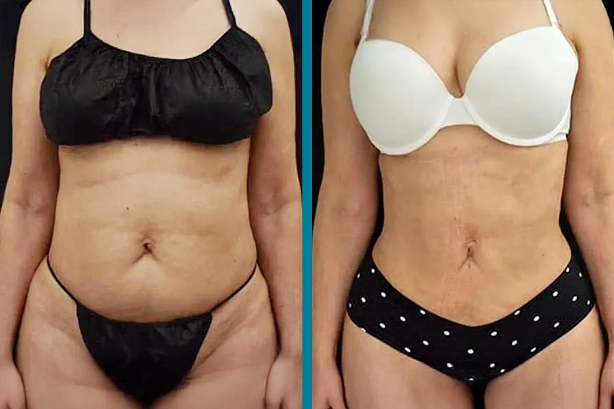 c'est quoi lipo Liposuccion Paris ou lipoaspiration de la graisse du corps main image 0